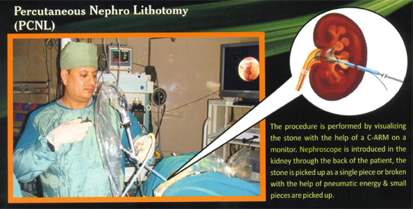 Percutaneous Nephro Lithotomy (PCNL)