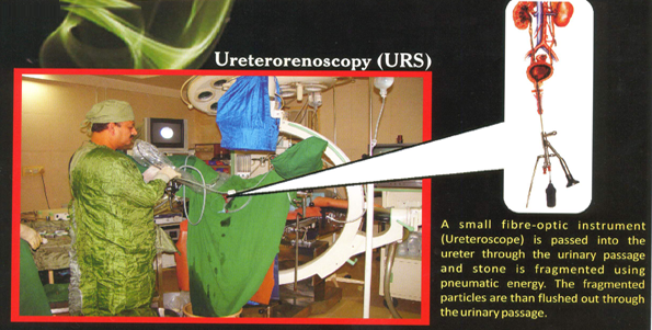 Ureterorenoscopy (URS)